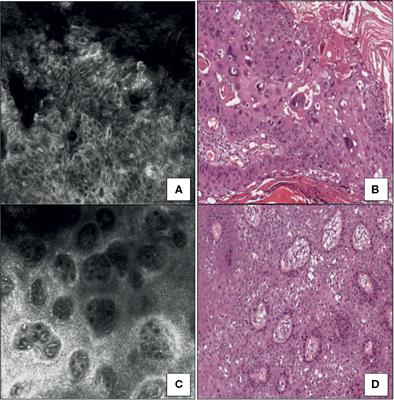 Correlation Between In Vivo Reflectance Confocal Microscopy and Horizontal Histopathology in Skin Cancer: A Review